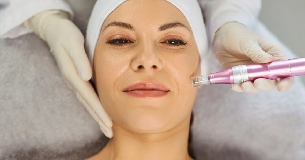 Women receiving Klardie with Microneedling In Lake Charles, LA